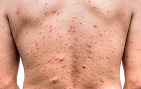 В России зарегистрирован первый случай оспы обезьян