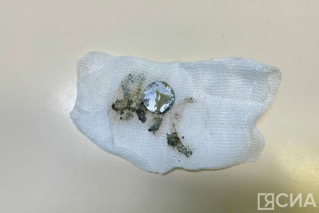 Годовалый ребенок проглотил литиевую батарейку и получил тяжелые ожоги пищевода