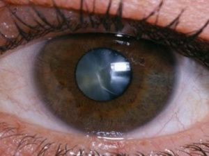 Офтальмологи Якутской городской больницы №3 расскажут о катаракте