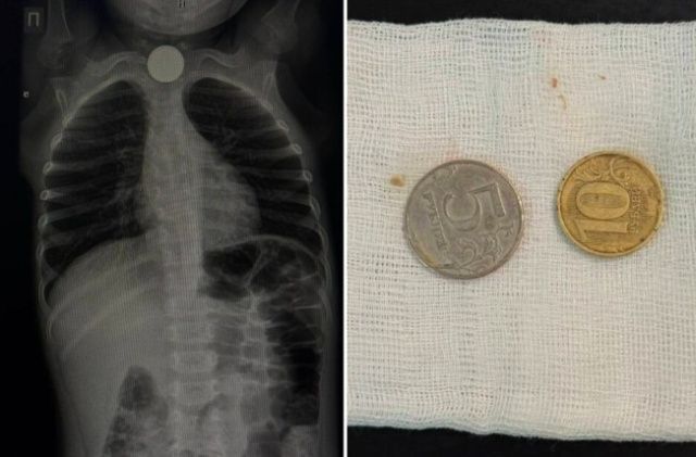 В Якутии трехлетний мальчик проглотил две монеты номиналом 5 и 10 рублей