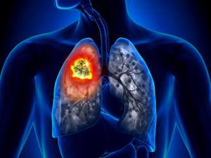 В Якутии стартовала кампания по профилактике рака лёгких