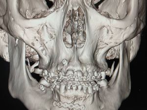 Как не потерять лицо после драки:  интервью челюстно-лицевого хирурга