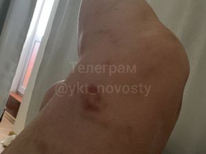 «Он бил меня до потери сознания»: якутянка рассказала о побоях в отношениях