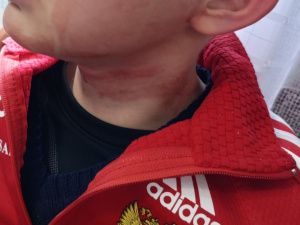 Назару, искусанному бродячими псами, администрация Алдана заплатит 200 тысяч морального вреда