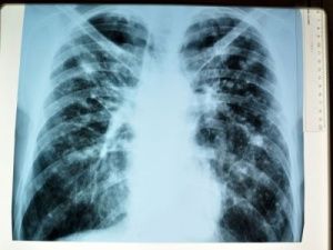 В Якутии в сформировавшемся в Усть-Майском районе очаге туберкулеза ведутся противоэпидемические мероприятия