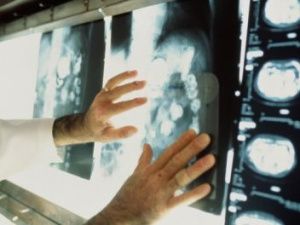 Минздрав Якутии об онкологической ситуации в Вилючане