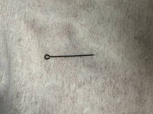 Острая боль: В Якутии женщина проглотила булавку, которая воткнулась в слизистую желудка