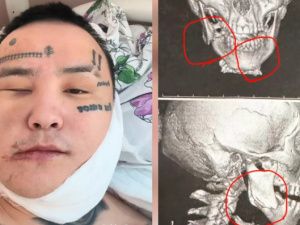 Певцу KitJah сломали челюсть в результате жестокого избиения