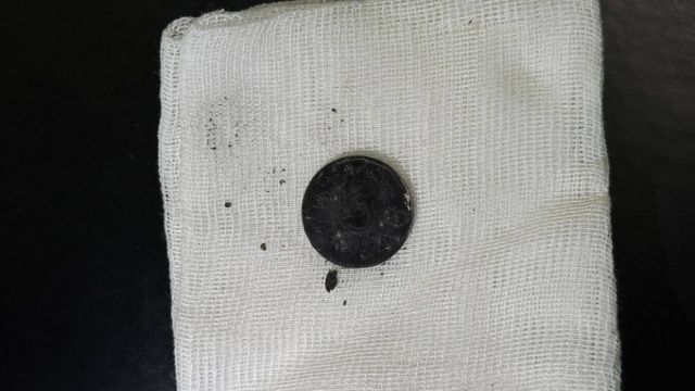 В Якутии в пищеводе годовалой девочки обнаружили монету