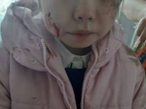 В Якутске на девочку напали собаки?