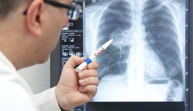 В Якутии у троих больных коронавирусной инфекцией диагностирована пневмония, проходящая бессимптомно