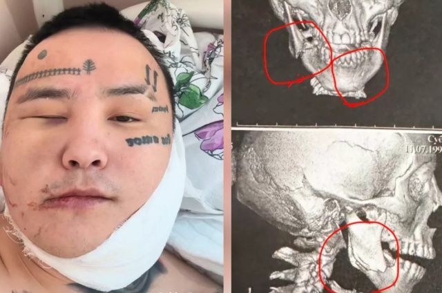 Певцу KitJah сломали челюсть в результате жестокого избиения