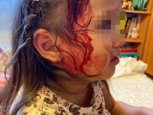 В Якутске неизвестный выстрелил в 4-летнюю девочку из пневматического ружья