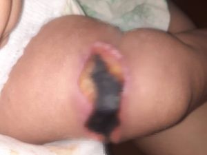 В Якутске у 8-месячного малыша после прививки начался абсцесс. Назначена пересадка кожи