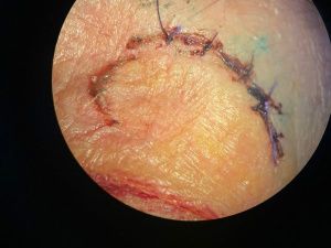 В Якутии 60-летняя женщина может лишиться зрения, получив стулом по голове на встрече выпускников