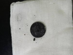 В Якутии в пищеводе годовалой девочки обнаружили монету