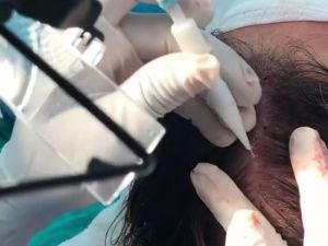 Якутский модельер сделал операцию по пересадке волос