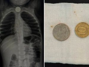 В Якутии трехлетний мальчик проглотил две монеты номиналом 5 и 10 рублей