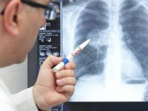 В Якутии у троих больных коронавирусной инфекцией диагностирована пневмония, проходящая бессимптомно