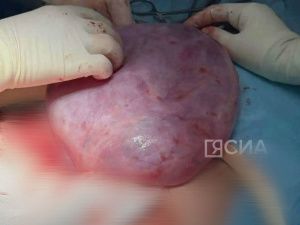 Якутским врачам удалось спасти 30-летнюю женщину с гигантской кистомой яичника