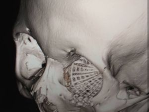 Как не потерять лицо после драки:  интервью челюстно-лицевого хирурга