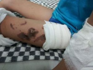 В Якутии 8-летнего мальчика ударил током обвисший провод ЛЭП