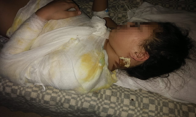 Шок. В Якутии медики сначала подожгли ребенка на операционном столе, а потом едва не ослепили