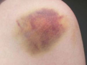 Якутского стилиста избили агрессивные лесбиянки