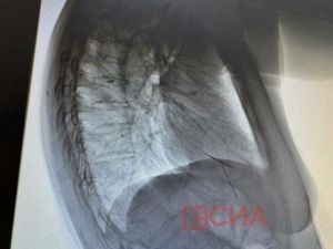 Швейная игла попала в лёгкие 57-летней якутянки