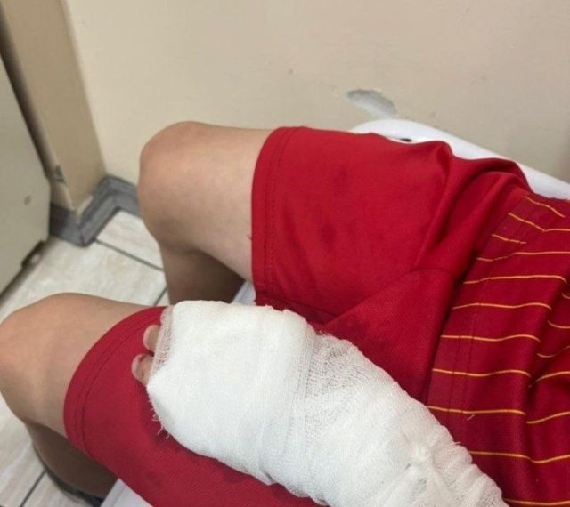 В Алдане покусанный собакой ребенок почти месяц страдает от ран, но никто еще не ответил за нападение животного