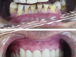 Известный якутский пародист вставил зубы в Китае!