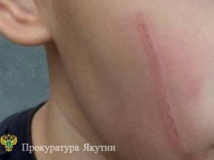 С управляющей компании в Якутске взыскали 150 тысяч рублей за причинение вреда ребенку