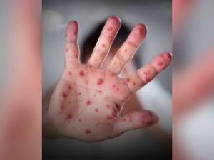 В Якутске шесть человек заболели корью. Карантин пока не объявлен