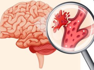 Пять предвестников инсульта