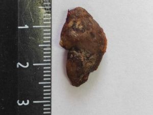 Операция на грани невозможного