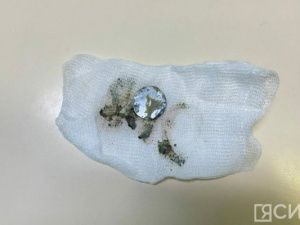 Годовалый ребенок проглотил литиевую батарейку и получил тяжелые ожоги пищевода