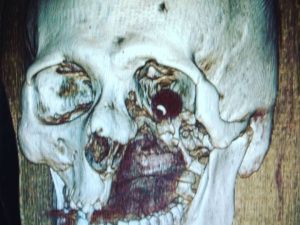 Как не потерять лицо после драки:  интервью челюстно-лицевого хирурга