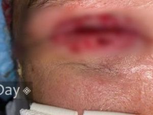 Житель Якутии лишил своего друга зрения, выплеснув марганцовку в глаз