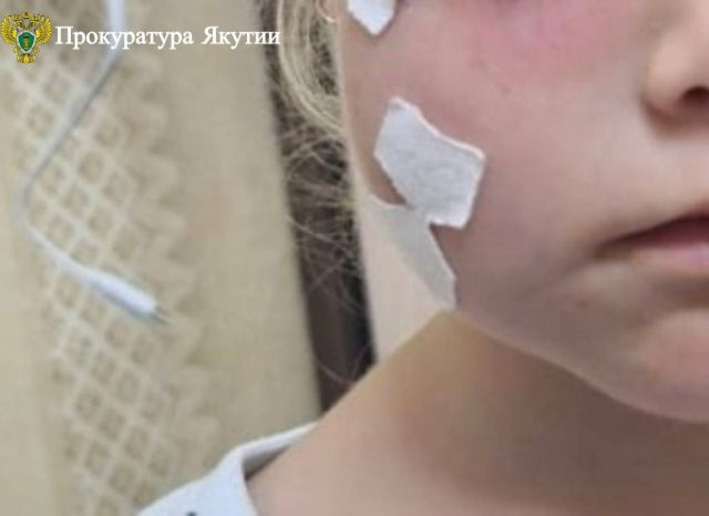 В Нерюнгри бездомная собака укусила трехлетнюю девочку за лицо: С администрации города взыскана компенсация