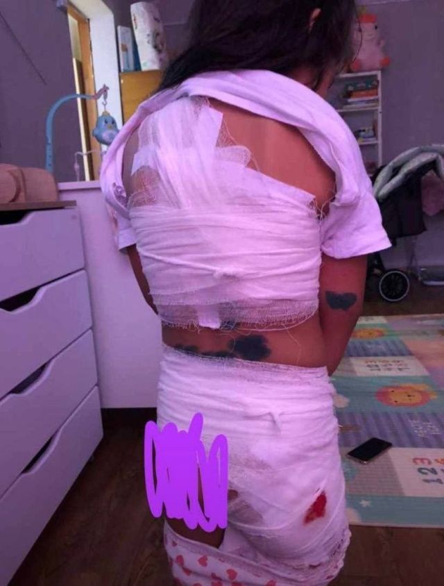 В Вилюйске на 4-летнюю девочку напали собаки. Администрация города заплатит 150 тысяч