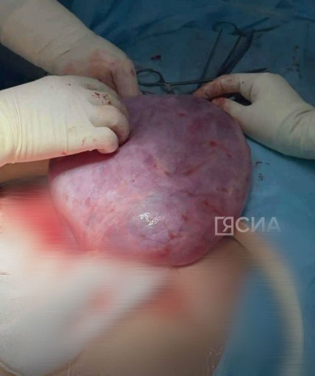 Якутским врачам удалось спасти 30-летнюю женщину с гигантской кистомой яичника