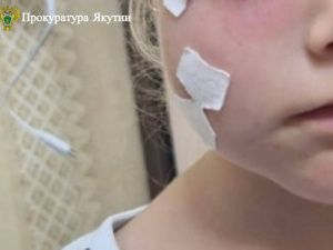 В Нерюнгри бездомная собака укусила трехлетнюю девочку за лицо: С администрации города взыскана компенсация