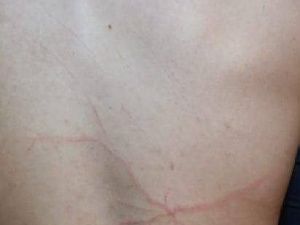 В Якутии молния ударила находящегося внутри дома молодого человека: Комментарий Хангаласской ЦРБ