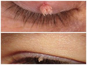 Чем опасны папилломы?