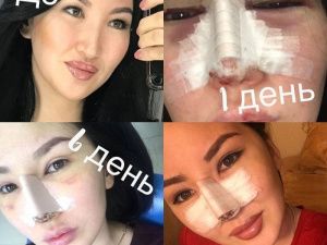 Известная якутская красавица сделала сразу две пластические операции на лице