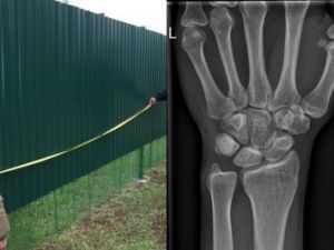 Житель Якутска сломал руку соседу за демонтаж его забора