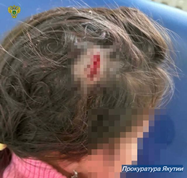 По иску прокуратуры детский сад в Олекминском районе выплатит 105 тысяч рублей за травму ребенка
