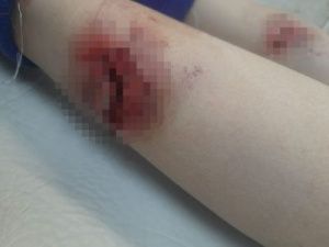 Собака напала на ребенка