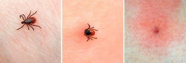 В Якутии зарегистрировано 498 случаев укуса клещами