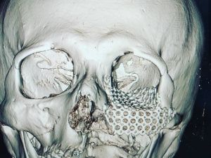 Как не потерять лицо после драки:  интервью челюстно-лицевого хирурга